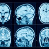 New Study Adds to Evidence Depo-Provera Injections Cause Meningioma Brain Tumor Risks