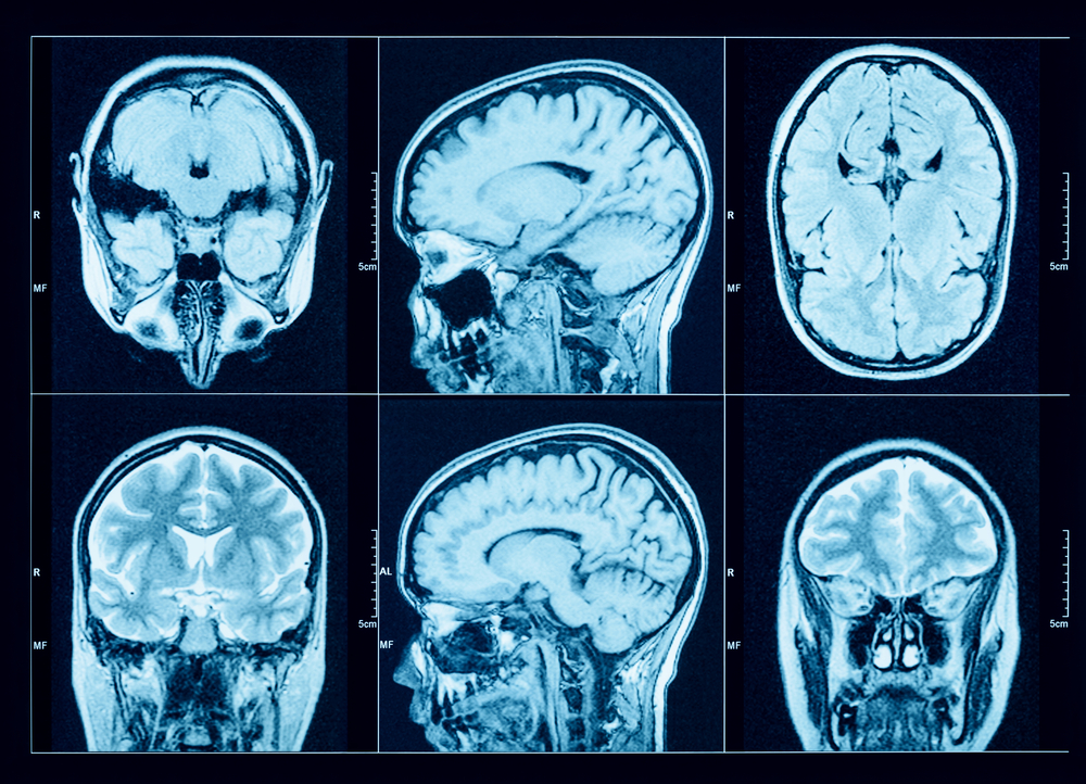 New Study Adds to Evidence Depo-Provera Injections Cause Meningioma Brain Tumor Risks
