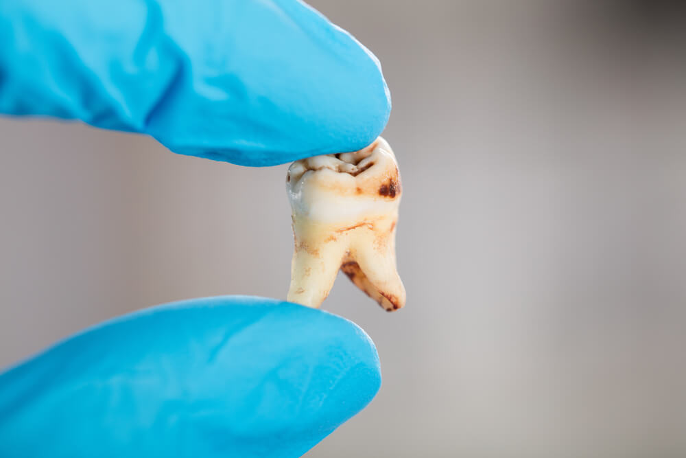 Suboxone Dental Decay Lawsuits Outline How Drug Causes LongTerm Damage
