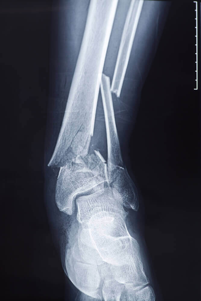 Synthroid Similar Thyroid Drugs Linked Bone Loss