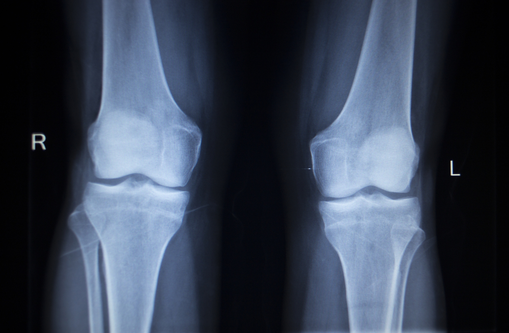 Zimmer Biomet Bone Cement Lawsuit Filed Over Failed Knee Replacement