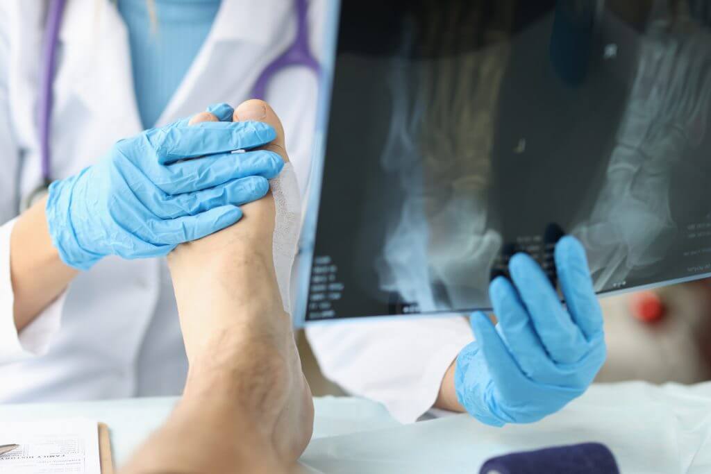 Lawsuits Over Cartiva Toe Implant Complications Voluntarily Withdrawn