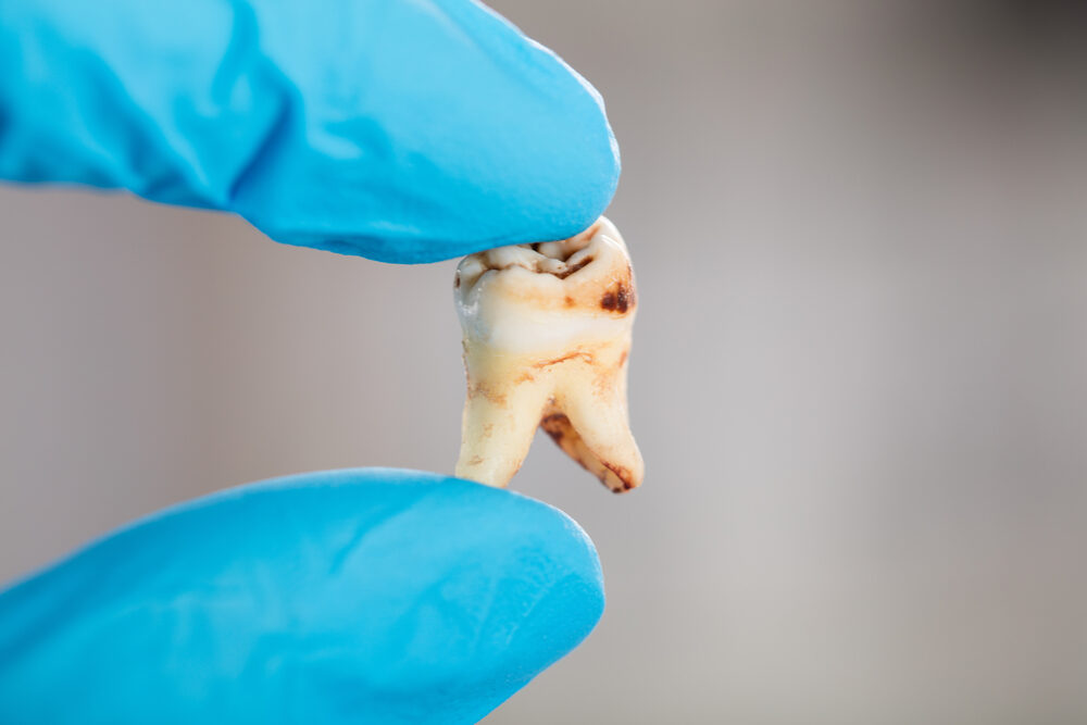 Suboxone Dental Decay Lawsuits Outline How Drug Causes LongTerm Damage