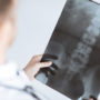 Prolia Discontinuation Increases The Risk Of Vertebral Fractures, Study Found