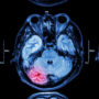 Study Links Traumatic Brain Injuries to Increased Risk of Stroke