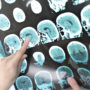 Higher Risk Of Recurring Brain Bleeds Linked to SSRI Antidepressant Side Effects