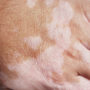 Chemical Leukoderma from Daytrana Skin Patch Causes Permanent Scarring