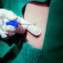 Using Gadolinium Contrast Dye with Epidural Steroid Injections Linked to 