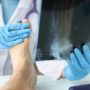Lawsuits Over Cartiva Toe Implant Complications Voluntarily Withdrawn, Without Prejudice
