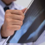 Cartiva Failure Rates Higher Than Toe Implant Patients Were Led to Believe, Lawsuits Allege