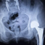 Exactech Hip Replacement Lawsuit Filed Over 