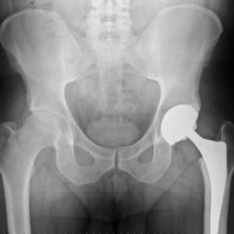 DePuy ASR Metal Hip Replacement Linked to High Failure Rate