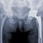 Exactech Connexion GXL Liner Lawsuit Filed After Hip Replacement Failed After Only Four Years