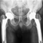 DePuy Pinnacle Hip Failures and Revision Surgery Rates Unacceptably High: Study