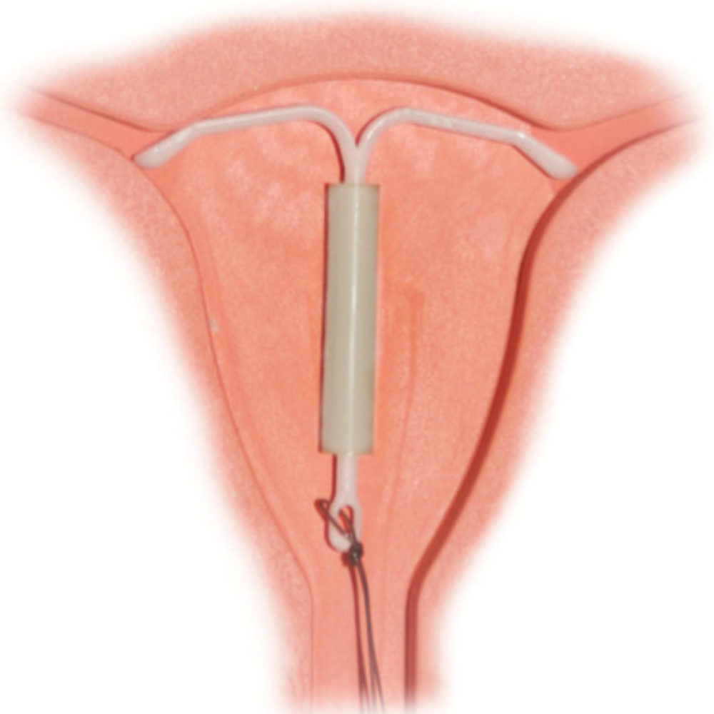 Iud Fell Out