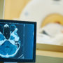 Recent Strokes May Increase Gadolinium Brain Deposition Following MRI with Contrast: Study